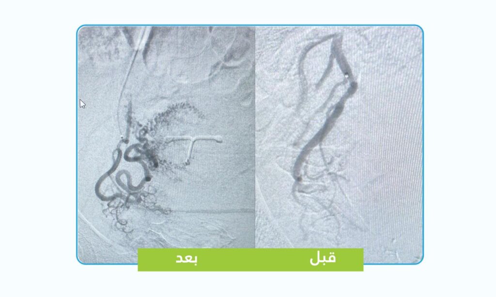 تقنية متقدمة بالأشعة التداخلية وقسطرة الأوعية الدموية تنهي معاناة مريضة من تغدد الرحم دون تدخل جراحي